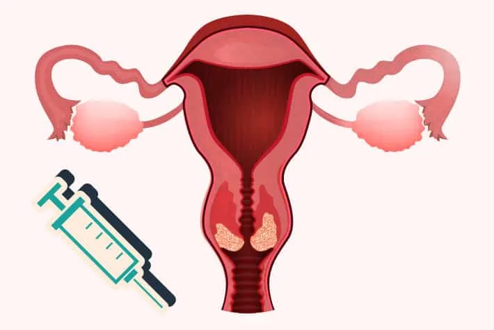 Embolização de Miomas Uterinos