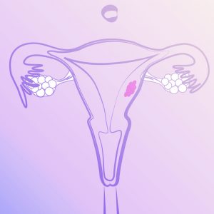 Mioma Uterino
