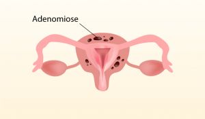 Saiba mais sobre adenomiose
