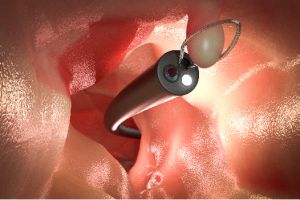Pólipo Endocervical