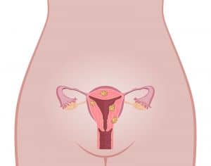 Os Tipos de Miomas Uterinos