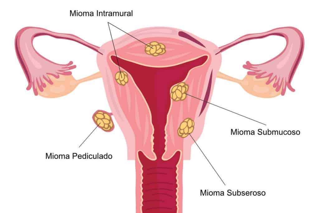 Desenho de um útero acometido por miomas de diferentes tipos. 