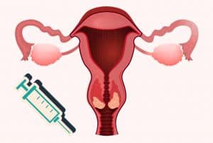 Embolização de Miomas Uterinos