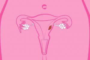 Mitos Sobre Miomas Uterinos
