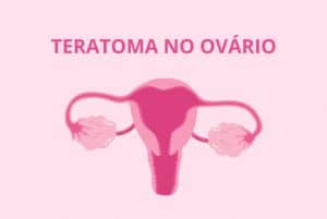 Teratoma no Ovário