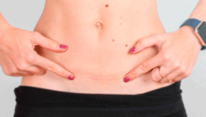 Endometriose em Cicatriz Cirúrgica