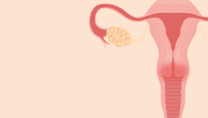 O que é Cervicite?