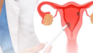 pólipo endometrial e pólipo endocervical