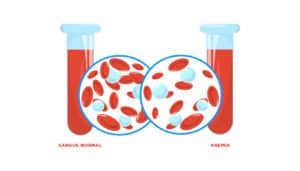 Anemia e Miomas Uterinos